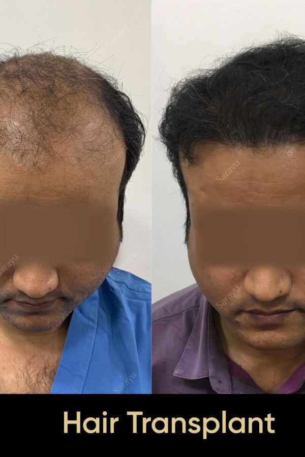 Close-up of healthy scalp with restored hair after a hair transplant procedure in Delhi.