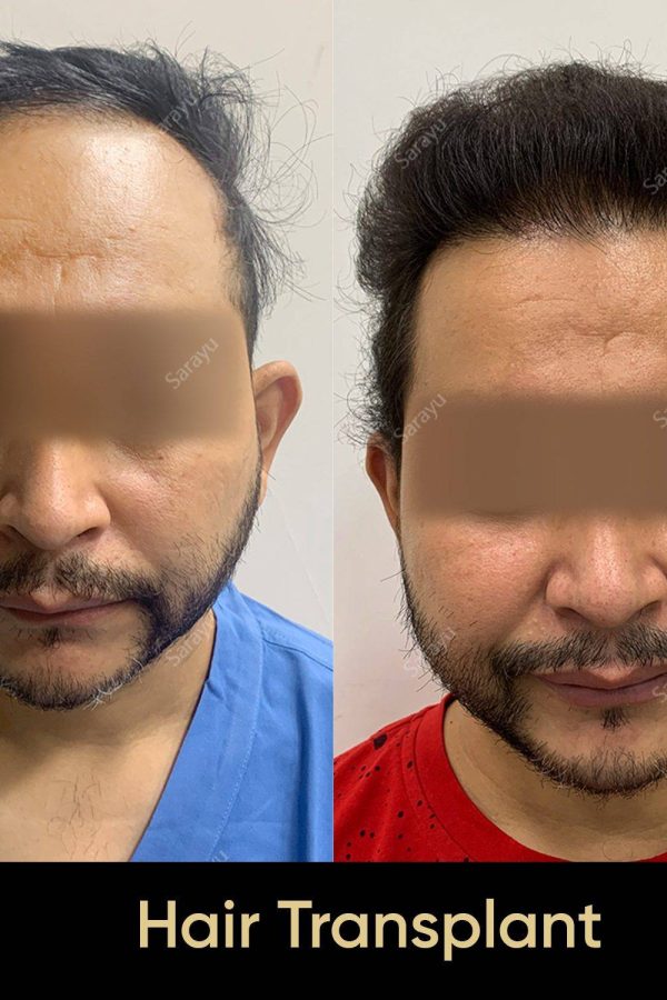 Close-up of healthy scalp with restored hair after a hair transplant procedure in Delhi.